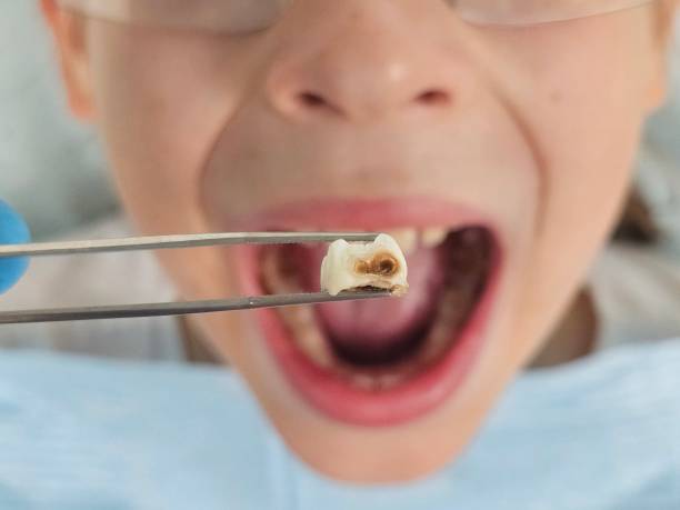 Best Emergency Dentist for Lost Fillings or Crowns in Lebanon, IN
